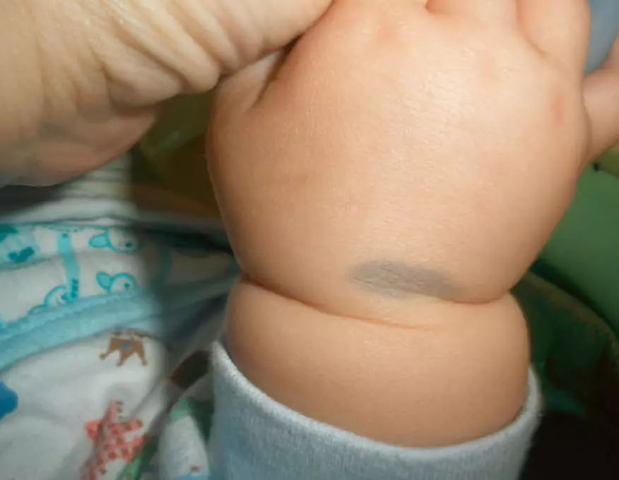 宝宝身上有不光滑胎记,宝宝身上胎记不哭就没有