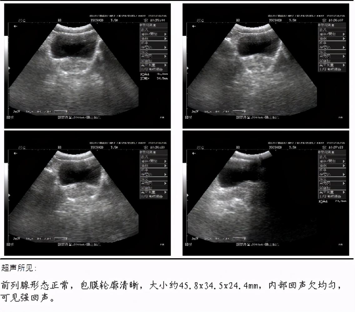 3个方法轻松解决前列腺疾病,如何快速有效的治疗前列腺疾病