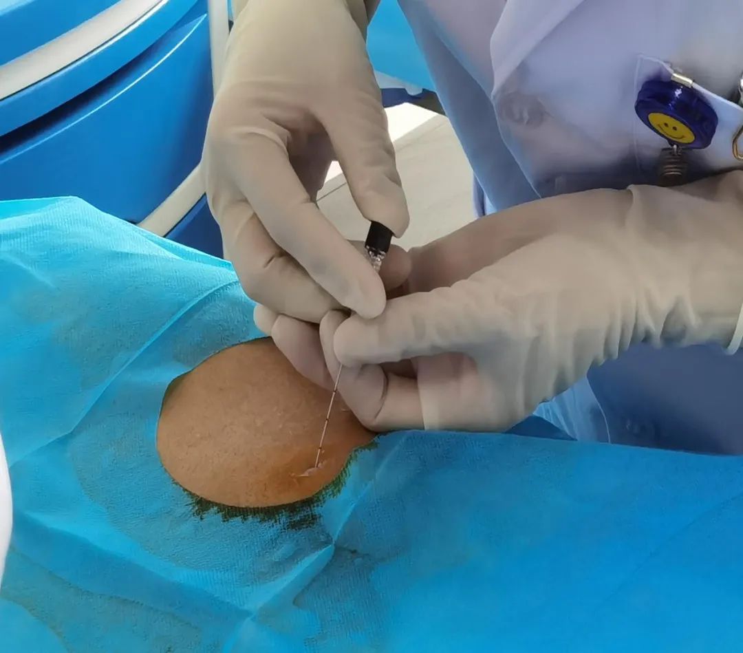 市中医院针灸科,神经阻滞针灸治疗效果