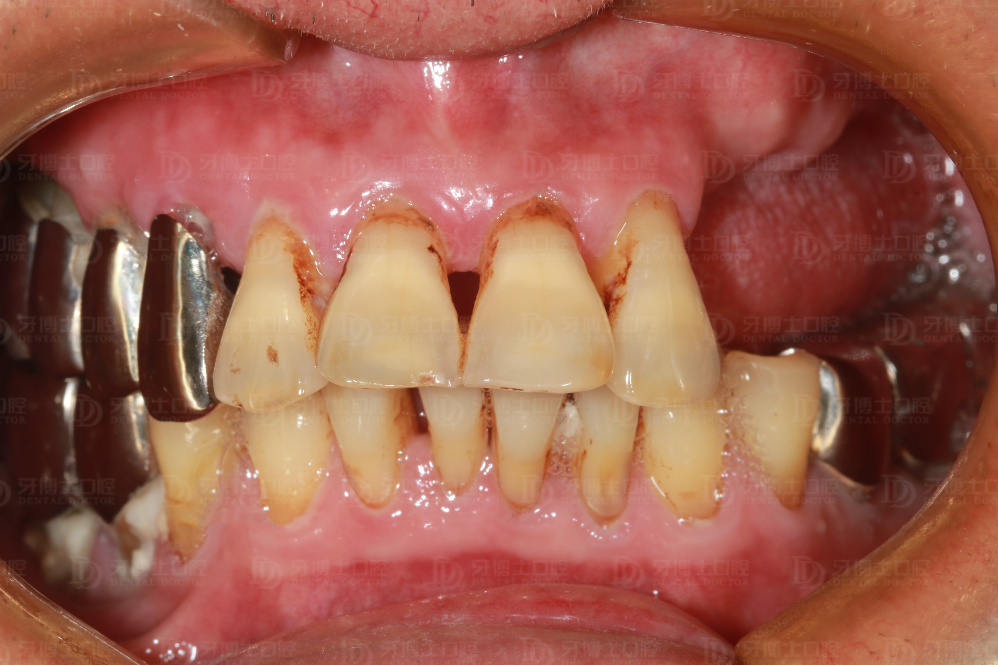 有牙根的缺牙不补,缺牙不补上面的牙掉下来