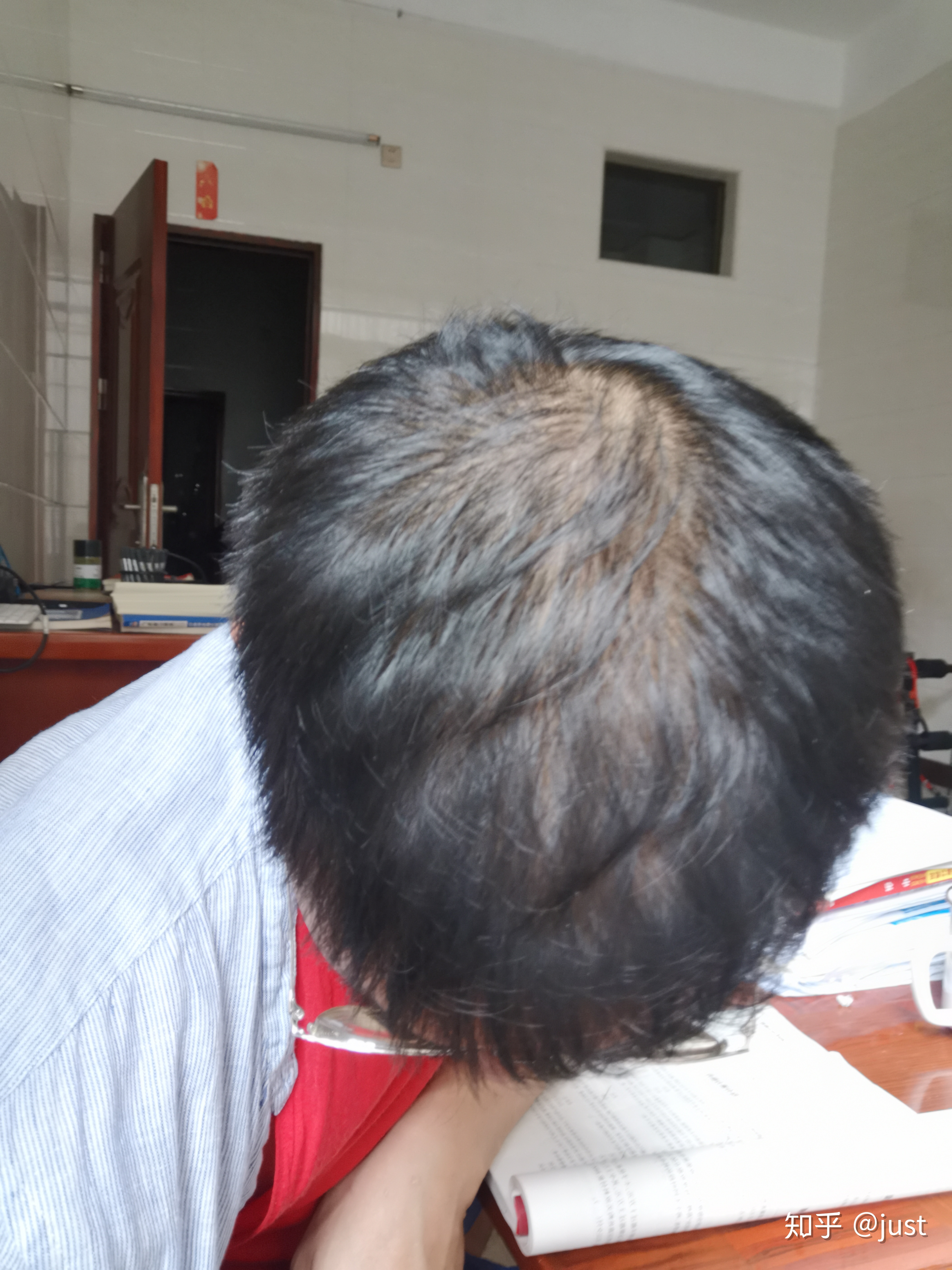 雄激素脱发单用米诺地尔,米诺地尔治女性脱发案例