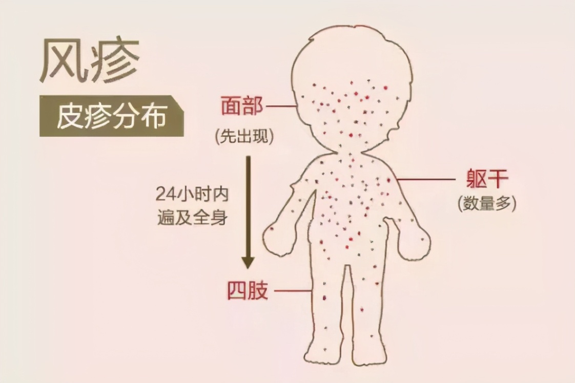 风疹预防健康宣教,风疹预防知识图片