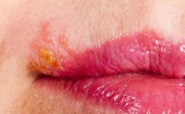 嘴唇长泡引起溃烂,嘴唇上火起水泡和疱疹区别