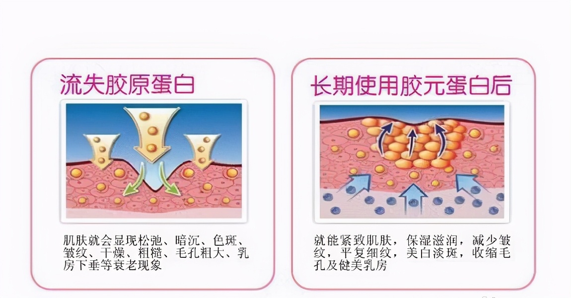 如何消除眼角皱纹和抬头纹的方法,消除川字纹和抬头纹最有效的方法