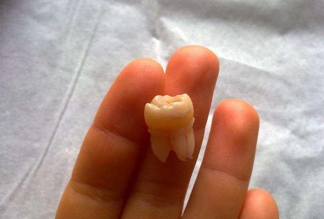 牙医建议拔牙就一定要拔吗,牙医总劝你拔牙