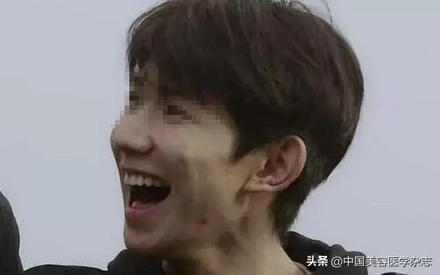 不怕人设崩塌，就怕皮肤太差！治疗重、中、轻*疮痤**临床论文分享！