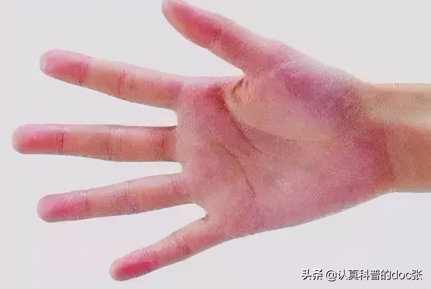 乙肝可以自愈吗,乙肝能自愈的吗