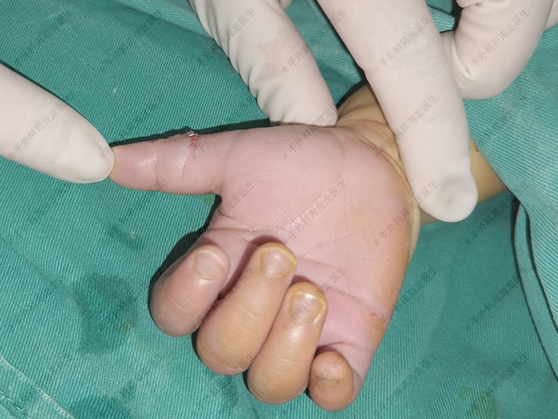 先天性斜指畸形手术修正,复指斜指畸形矫正