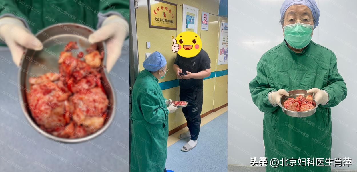 腺肌病保宫疗法,腺肌症怎么干预