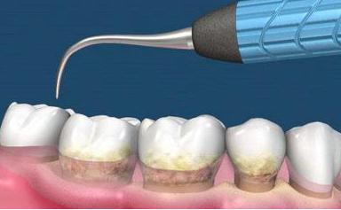 牙结石太顽固了怎么能把它抠掉,牙结石不管它会严重吗