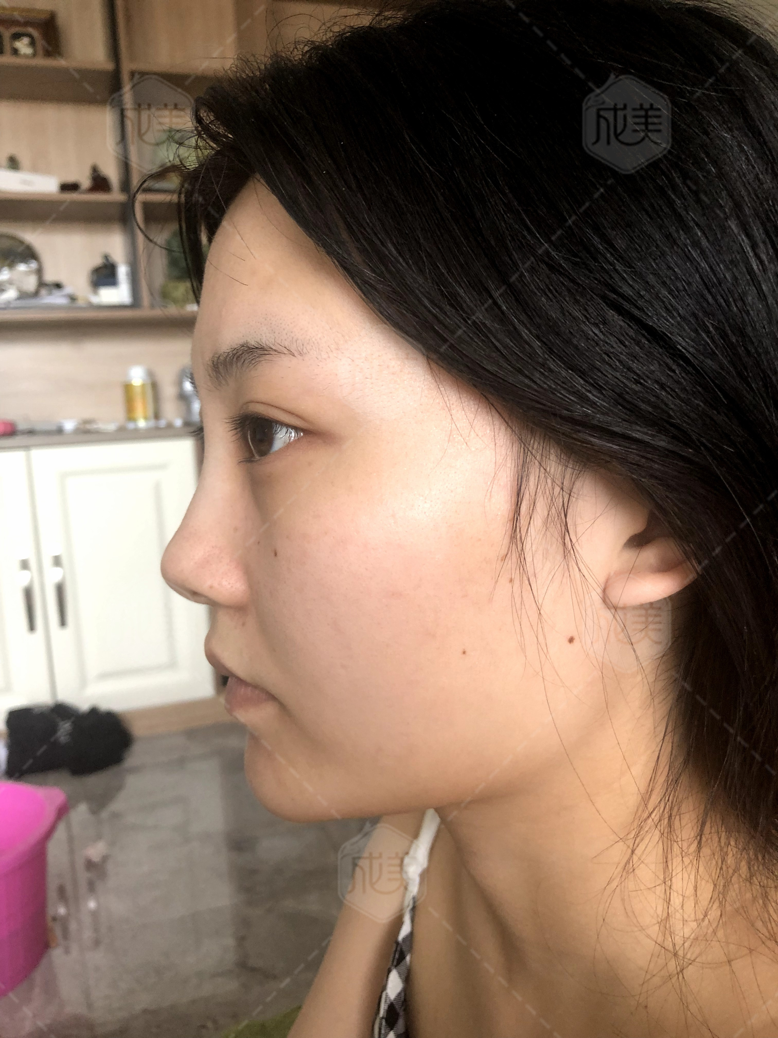 硅胶隆鼻没效果修复遭罪吗,硅胶假体隆鼻不满意最佳取出时间