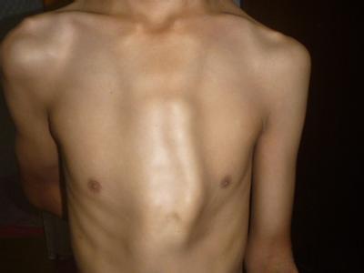 轻度的鸡胸和漏斗胸如何治疗,轻度鸡胸需要治疗吗