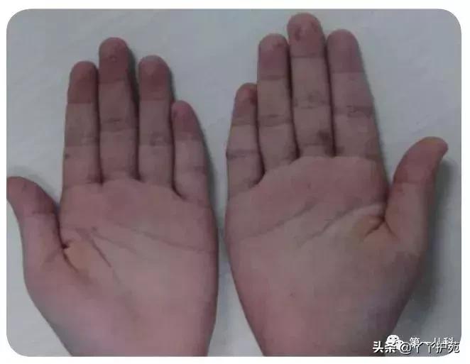 手足口病水痘荨麻疹有什么区别,麻疹水痘手足口病皮疹的区别