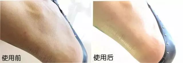 冬天手脚裂口,手脚冬天裂口怎么治疗