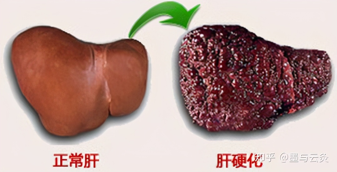 肝硬化腹部积水一般都是癌症,癌症胸腔积液腹部积水能活多久