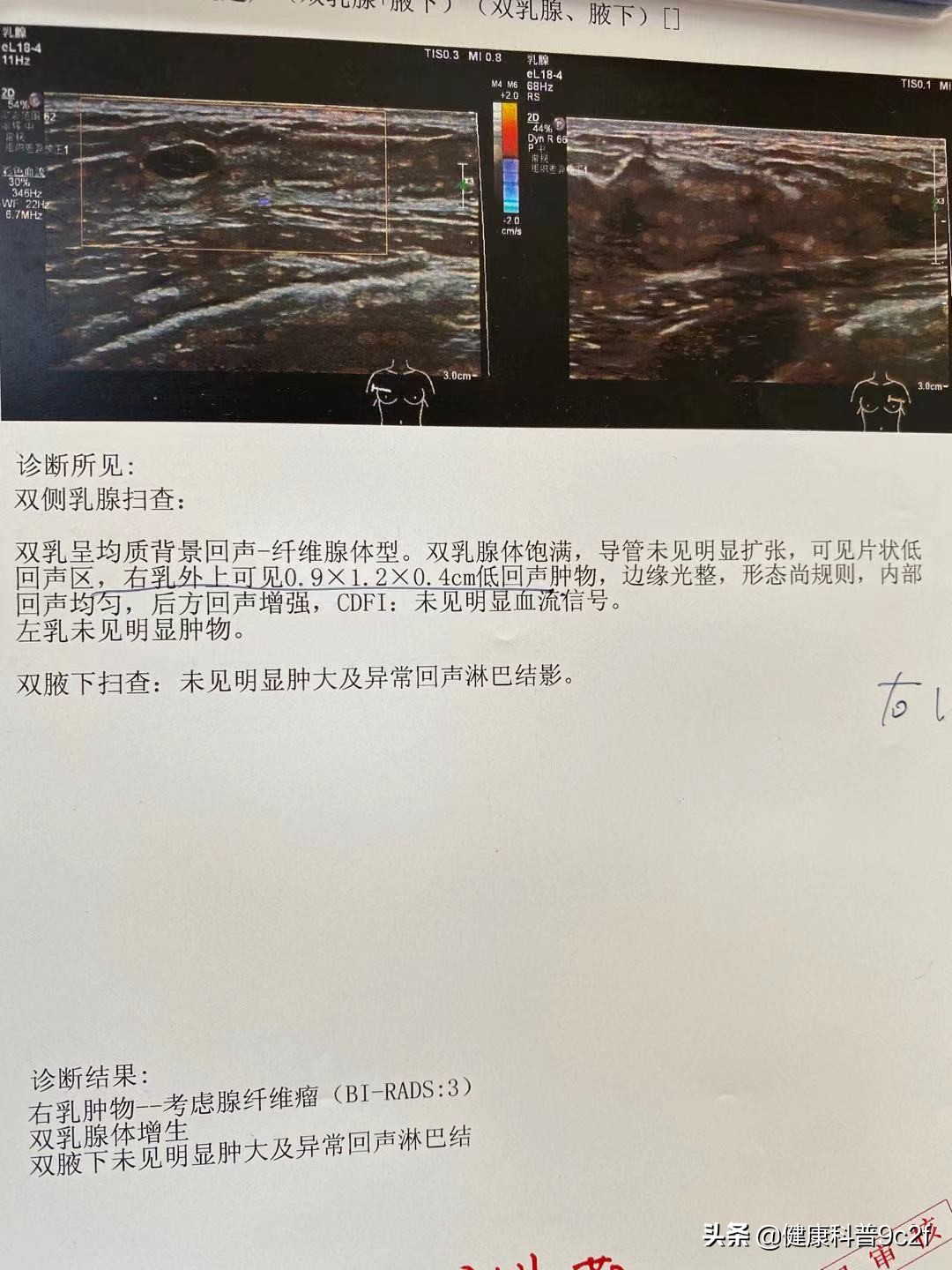 年轻人乳腺增生怎么办,年轻人乳腺增生最佳消除方法