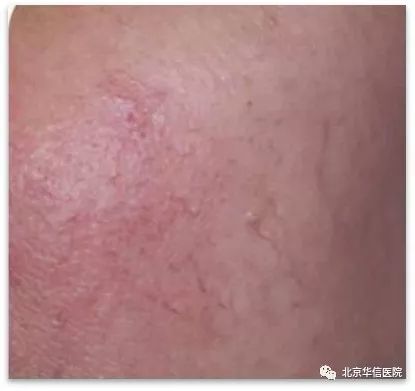 光子嫩肤帮你逆袭光滑细嫩态势,光子嫩肤让你拥有蛋壳般肌肤