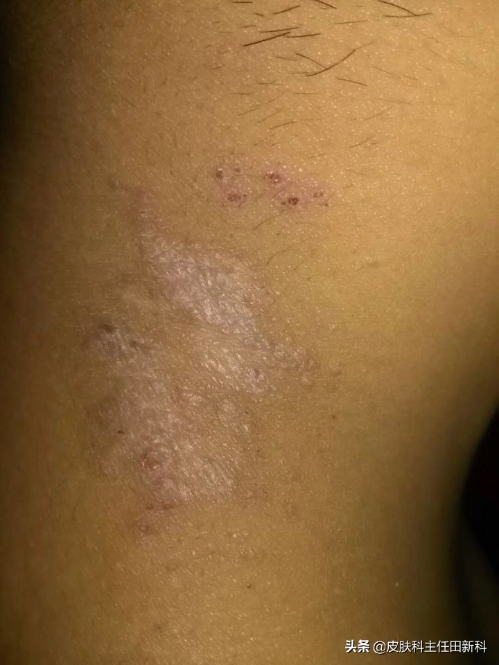 真菌感染性皮肤病原因,人真菌皮肤病怎么治