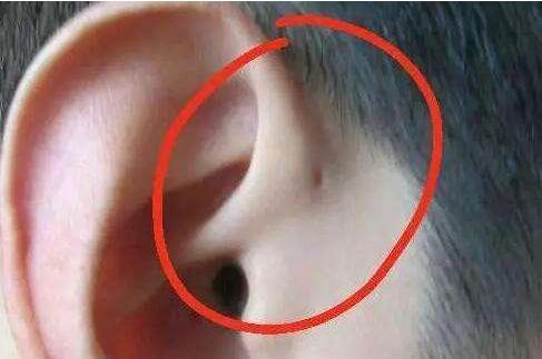 新生儿耳朵旁边有个小洞,耳朵旁边的小洞