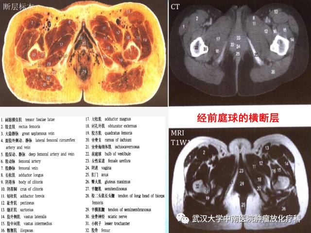 女性盆腔解剖与断层影像
