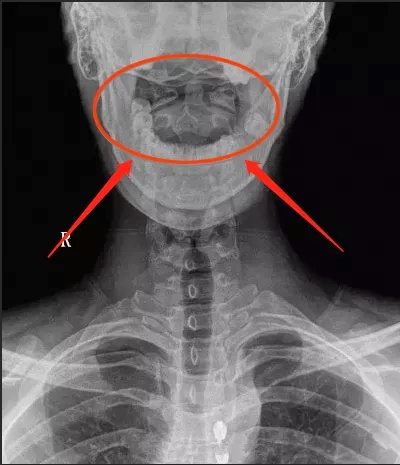 过敏性鼻炎变严重了,过敏性鼻炎导致体质变差