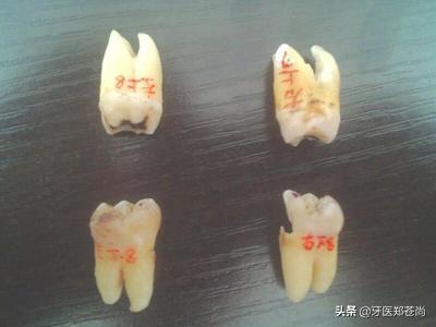 没长出来的智齿拔了不痛正常吗,为什么智齿没长出来却总是疼呢