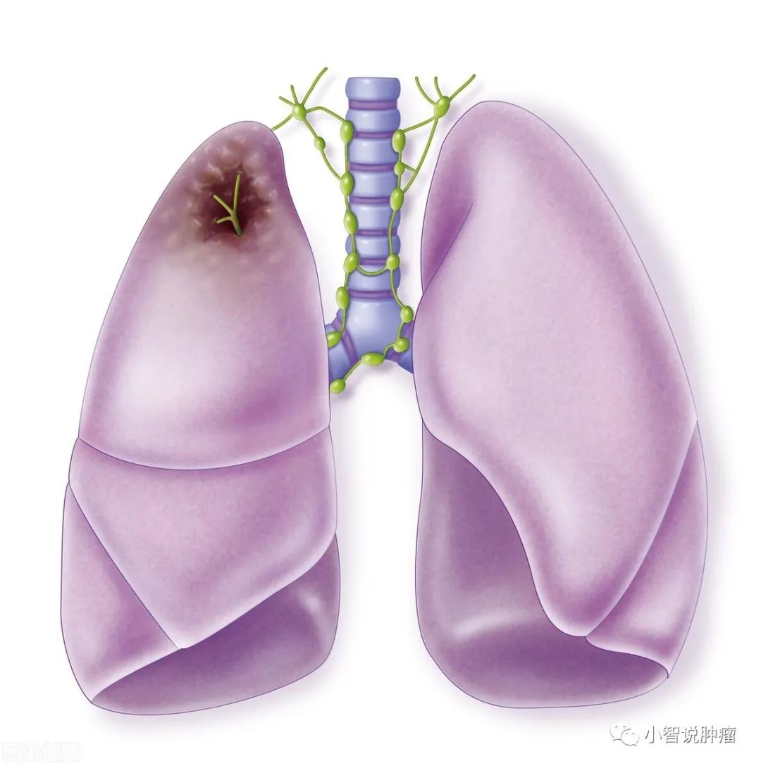 年年体检却查出癌晚期,年年体检正常却被诊断为癌症晚期