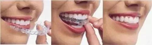 动画模拟牙齿矫正前后会变美,做了矫正牙齿会反弹吗