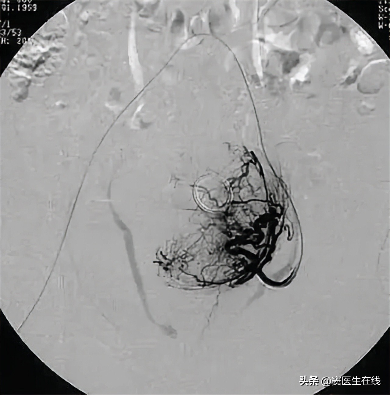 子宫腺肌症痛经最简单的止痛方法,子宫腺肌症痛经是腹部什么部位疼