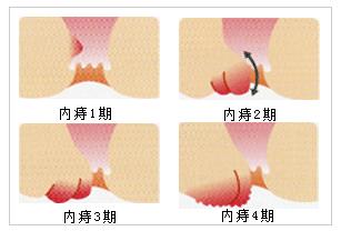 两个肉球脱出是什么痔疮,掉出肉球是痔疮吗