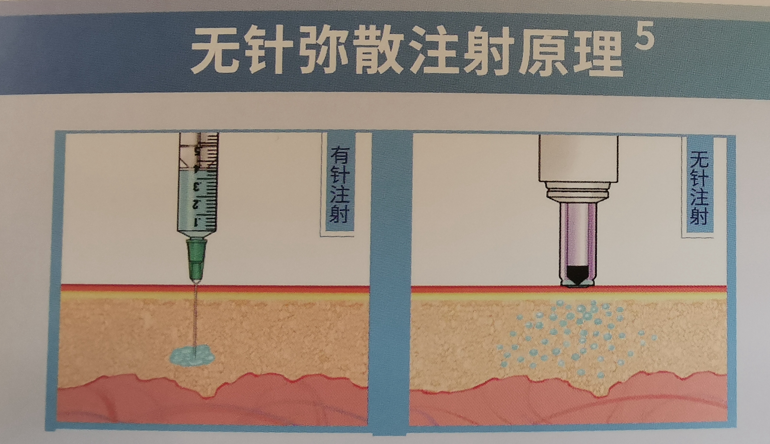 肚皮打针疼痛难忍,肚皮打针疼痛