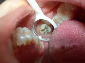 拔大牙烂牙根,烂牙根没拔干净