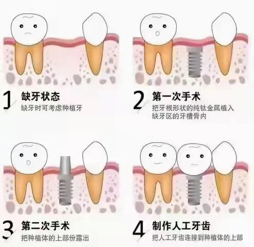 种植牙手术流程图解,口腔种植牙护士手术配台流程