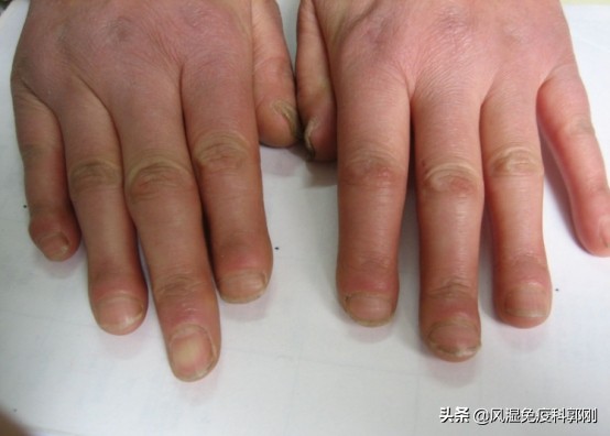 硬皮病要关注哪些日常保养,硬皮病的健康指导