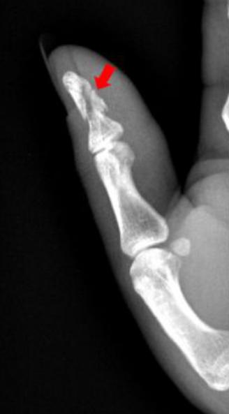 怎样发现骨折的可能性,一招看出手指骨折