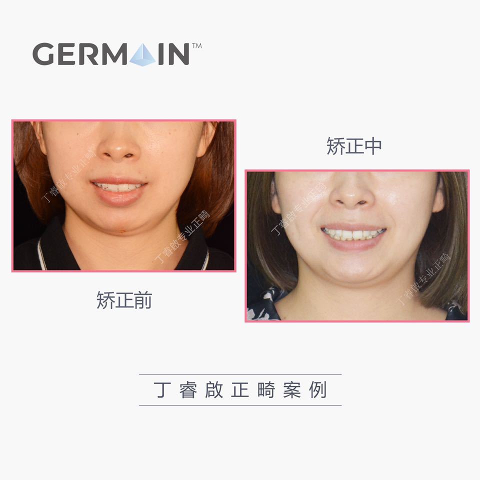 郑州牙齿矫正丁睿啟｜下巴后缩病例合集