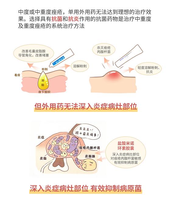 痘痘严重爆发，口服抗生素治疗安全有效吗？