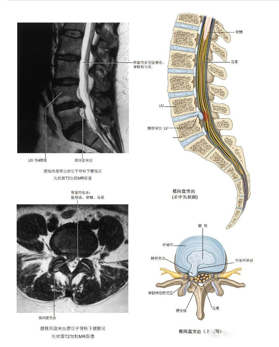椎间盘突出病案分析,腰椎间盘突出做手术好久恢复正常