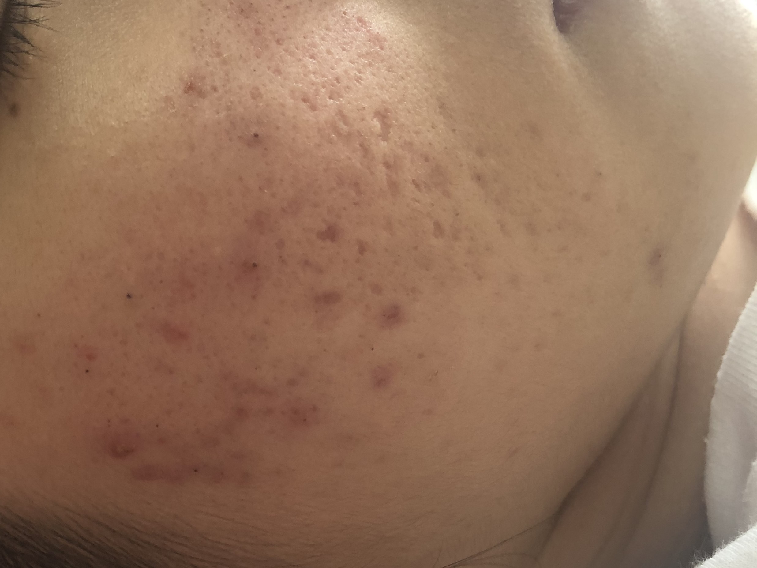 17岁女儿脸上长很多痘痘粉刺,12岁女儿脸上长满痘痘怎么办