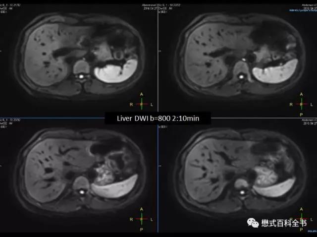 dwi成像序列,dwi序列和edwi序列