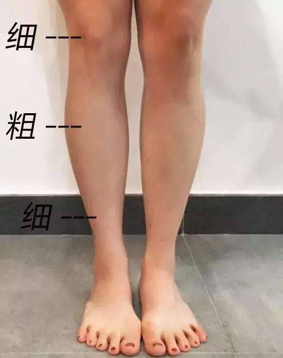 明明很瘦但是腿粗怎么办,天生腿粗可以变成筷子腿吗