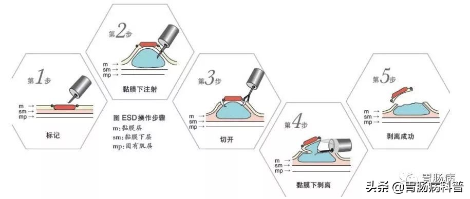 胃息肉在线解答,胃息肉科普视频参赛作品