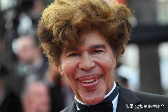 面中部凹陷下巴微翘,朱元璋式下巴怎么矫正