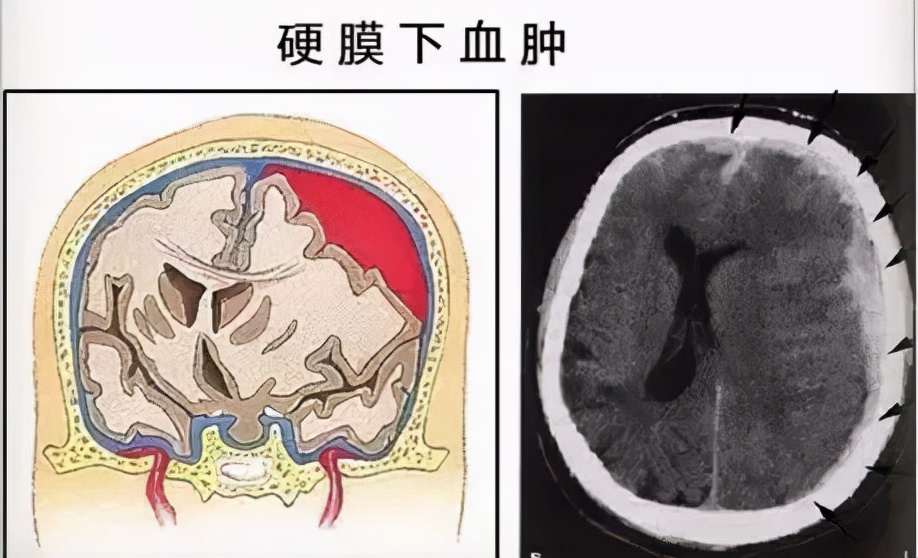摔跤后有脑血肿怎么处理,轻微摔伤怎么处理