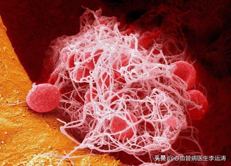 病人血小板低该吃什么药防治心梗,预防心梗复发阿司匹林用量