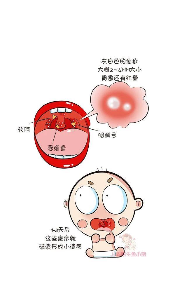 疱疹性咽峡炎怎么预防和减轻症状,疱疹性咽峡炎和手足口有什么差别