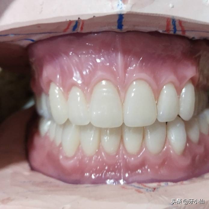 老人牙齿全坏了怎么办,老人牙掉了剩几颗怎么修复