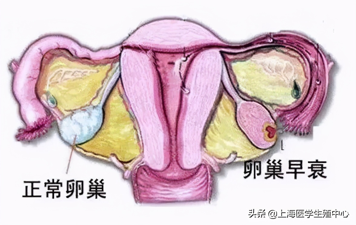试管婴儿取完卵防止腹水,试管婴儿取完卵后关注哪些事项