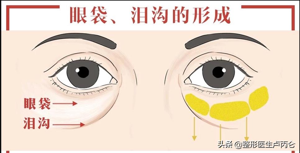外切眼袋有哪些并发症,眼袋手术有可能出现哪些并发症