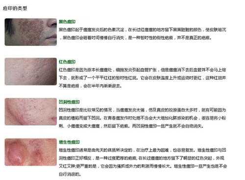 脸上有坑坑洼洼的痘印怎么消除,脸上坑坑洼洼女生